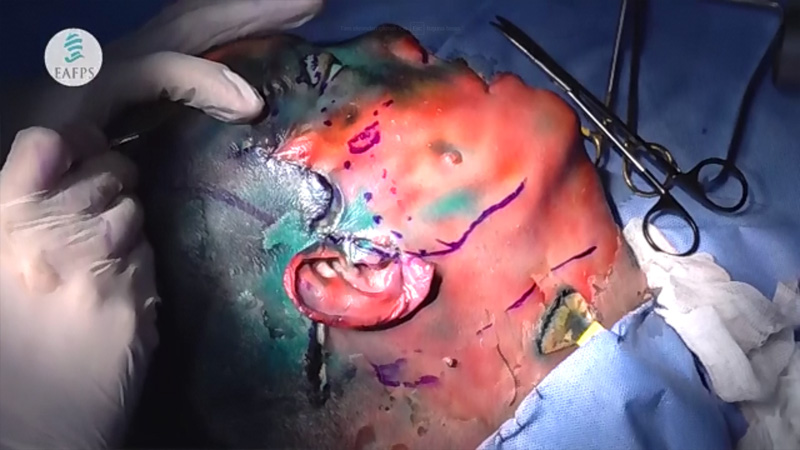 Browlift Techniques On Biomaterial   (Live Broadcast 07-8/04/2018