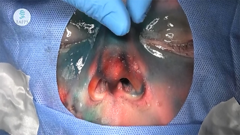 External Rhinoplasty On Biomaterial   (Live Broadcast 07-8/04/2018)